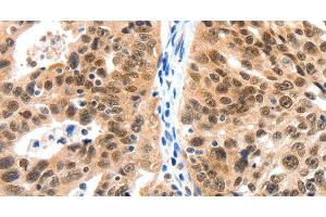 Immunohistochemistry of paraffin-embedded Human ovarian cancer tissue using LRP5 Polyclonal Antibody at dilution 1:115 (LRP5 Antikörper)
