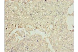 Immunohistochemistry of paraffin-embedded human lung cancer using ABIN7176007 at dilution of 1:100 (ZNF187 Antikörper  (AA 239-478))