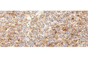 Immunohistochemistry of paraffin-embedded Human liver cancer using ZNF365 Polyclonal Antibody at dilution of 1/20 (ZNF365 Antikörper)