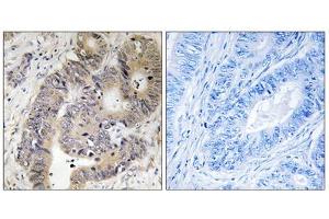 Immunohistochemistry analysis of paraffin-embedded human colon carcinoma tissue using CAD (Phospho-Thr456) antibody. (CAD Antikörper  (pThr456))