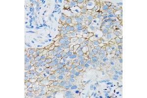 Immunohistochemistry of paraffin-embedded human lung cancer using CTNNA1 antibody (ABIN1876836) at dilution of 1:100 (40x lens).