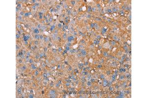 Immunohistochemistry of Human liver cancer using PAGE5 Polyclonal Antibody at dilution of 1:55 (PAGE5 Antikörper)