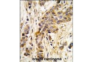 Formalin-fixed and paraffin-embedded human breast carcinoma tissue reacted with IARS2 antibody (Center) , which was peroxidase-conjugated to the secondary antibody, followed by DAB staining. (IARS2 Antikörper  (AA 600-628))