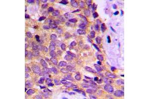 Immunohistochemical analysis of PRKAR1B staining in human breast cancer formalin fixed paraffin embedded tissue section. (PRKAR1B Antikörper  (Center))