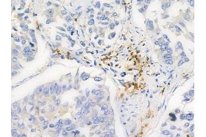 Phospho-RSK1 p90 (Thr359/Ser363) Antibody at 1/100 staining human lung squamous cell carcinoma by IHC-P.