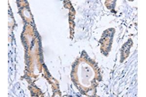 The image on the left is immunohistochemistry of paraffin-embedded Human colon cancer tissue using ABIN7189998(BOD1 Antibody) at dilution 1/30, on the right is treated with synthetic peptide. (BOD1 Antikörper)