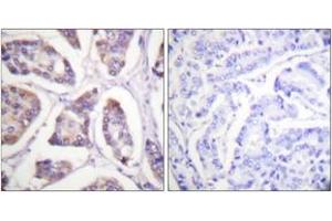 Immunohistochemistry analysis of paraffin-embedded human breast carcinoma tissue, using Vinculin (Ab-821) Antibody. (Vinculin Antikörper  (AA 786-835))