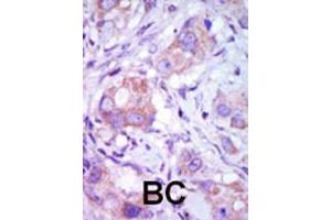 Formalin-fixed and paraffin-embedded human cancer tissue reacted with the primary antibody, which was peroxidase-conjugated to the secondary antibody, followed by DAB staining. (MAP3K9 Antikörper  (C-Term))