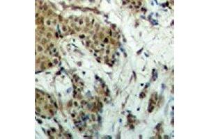 Immunohistochemical analysis of EVI1 staining in human breast cancer formalin fixed paraffin embedded tissue section.