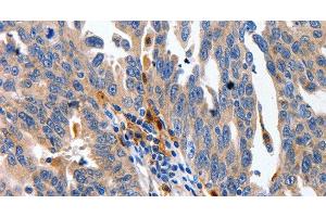 Immunohistochemistry of paraffin-embedded Human ovarian cancer using IL18 Polyclonal Antibody at dilution of 1:100 (IL-18 Antikörper)