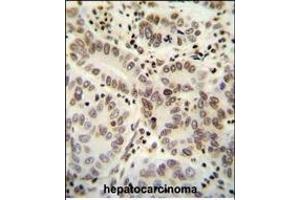 HIST1H2B antibody (Center) (ABIN654684 and ABIN2844377) immunohistochemistry analysis in formalin fixed and paraffin embedded human hepatocarcinoma followed by peroxidase conjugation of the secondary antibody and DAB staining. (HIST1H2BJ Antikörper  (AA 57-86))