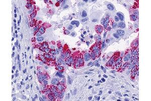 Anti-FFAR2 / GPR43 antibody IHC of human Pancreas, Carcinoma.