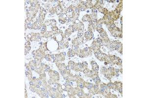 Immunohistochemistry of paraffin-embedded human liver injury using TSG101 antibody (ABIN5999112) at dilution of 1/100 (40x lens). (TSG101 Antikörper)