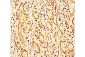 Immunohistochemistry of paraffin-embedded human gastric cancer using ABIN7152927 at dilution of 1:100 (FBLN7 Antikörper  (AA 25-393))