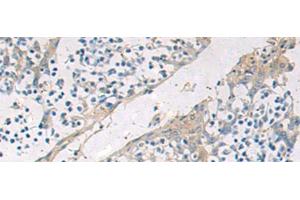 Immunohistochemistry of paraffin-embedded Human tonsil tissue using GBA Polyclonal Antibody at dilution of 1:55(x200) (GBA Antikörper)