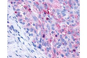 Anti-P2Y10 / P2RY10 antibody IHC of human Ovary, Carcinoma. (P2RY10 Antikörper  (C-Term))