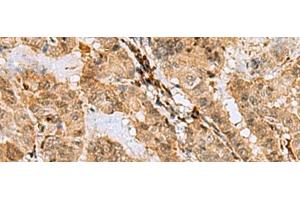 Immunohistochemistry of paraffin-embedded Human thyroid cancer tissue using ASNA1 Polyclonal Antibody at dilution of 1:70(x200) (ASNA1 Antikörper)
