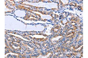 The image on the left is immunohistochemistry of paraffin-embedded Human thyroid cancer tissue using ABIN7191274(LIF Antibody) at dilution 1/25, on the right is treated with synthetic peptide. (LIF Antikörper)