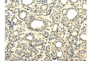 The image on the left is immunohistochemistry of paraffin-embedded Human thyroid cancer tissue using ABIN7131302(TBC1D22A Antibody) at dilution 1/25, on the right is treated with fusion protein. (TBC1D22A Antikörper)