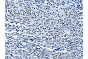 The image on the left is immunohistochemistry of paraffin-embedded Human ovarian cancer tissue using ABIN7190072(CBX1 Antibody) at dilution 1/30, on the right is treated with synthetic peptide. (CBX1 Antikörper)
