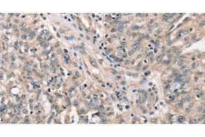 Immunohistochemistry of paraffin-embedded Human ovarian cancer tissue using CDK12 Polyclonal Antibody at dilution 1:30