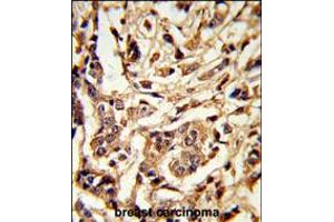 Formalin-fixed and paraffin-embedded human breast carcinoma reacted with GALT Antibody , which was peroxidase-conjugated to the secondary antibody, followed by DAB staining. (GALT Antikörper  (C-Term))