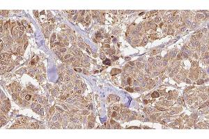 ABIN6276495 at 1/100 staining Human Melanoma tissue by IHC-P. (Neurotrophin 4 Antikörper  (Internal Region))
