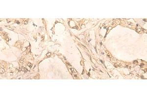 Immunohistochemistry of paraffin-embedded Human gastric cancer tissue using PLEKHA1 Polyclonal Antibody at dilution of 1:30(x200) (PLEKHA1 Antikörper)