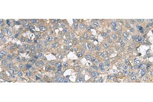 Immunohistochemistry of paraffin-embedded Human liver cancer tissue using CXCR5 Polyclonal Antibody at dilution of 1:80(x200) (CXCR5 Antikörper)