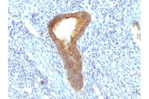 Formalin-fixed, paraffin-embedded human Endometrial Carcinoma stained with Alkaline Phosphatase Mouse Monoclonal Antibody (ALPL/597). (ALPL Antikörper)