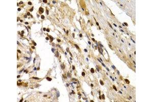 Immunohistochemistry of paraffin-embedded Human colon damage using TFDP1 Polyclonal Antibody at dilution of 1:200 (40x lens). (DP1 Antikörper)