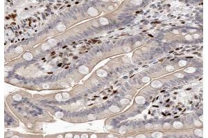 ABIN6266583 at 1/100 staining human colon carcinoma tissue sections by IHC-P.
