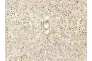 ABIN7093862 and ABIN7097905 at 1/100 staining human astrocytoma by IHC-P. (Dynamin 3 Antikörper  (C-Term))