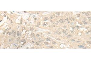 Immunohistochemistry of paraffin-embedded Human esophagus cancer tissue using CYP4X1 Polyclonal Antibody at dilution of 1:40(x200) (CYP4X1 Antikörper)