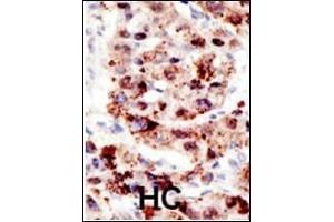Formalin-fixed and paraffin-embedded human cancer tissue reacted with the primary antibody, which was peroxidase-conjugated to the secondary antibody, followed by AEC staining. (Ubiquitin Antikörper  (AA 36-66))