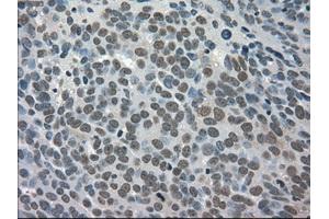 Immunohistochemical staining of paraffin-embedded Adenocarcinoma of breast tissue using anti-TRIB2 mouse monoclonal antibody. (TRIB2 Antikörper)