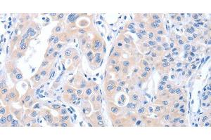 Immunohistochemistry of paraffin-embedded Human lung cancer tissue using ARHGEF6 Polyclonal Antibody at dilution 1:70 (ARHGEF6 Antikörper)