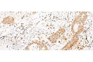 Immunohistochemistry of paraffin-embedded Human esophagus cancer tissue using PRKAG2 Polyclonal Antibody at dilution of 1:55(x200) (PRKAG2 Antikörper)