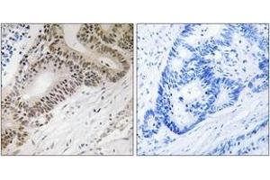 Immunohistochemistry analysis of paraffin-embedded human colon carcinoma tissue, using FOXO3A (Ab-315) Antibody. (FOXO3 Antikörper  (AA 281-330))
