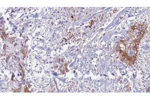 ABIN6269237 at 1/100 staining Human urothelial cancer tissue by IHC-P. (CD130/gp130 Antikörper  (C-Term))