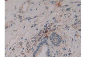 Detection of DNM2 in Human Liver cancer Tissue using Polyclonal Antibody to Dynamin 2 (DNM2)