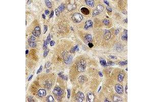 Immunohistochemical analysis of MPP2 staining in human liver cancer formalin fixed paraffin embedded tissue section. (MPP2 Antikörper)