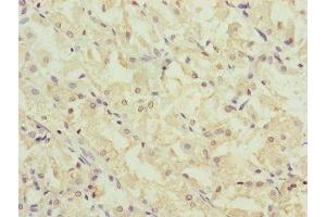 Immunohistochemistry of paraffin-embedded human gastric cancer using ABIN7147407 at dilution of 1:100 (CEP44 Antikörper  (AA 1-280))