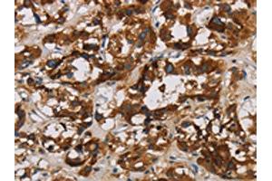 The image is immunohistochemistry of paraffin-embedded Human thyroid cancer tissue using ABIN7128636(BCL2L12 Antibody) at dilution 1/20. (BCL2L12 Antikörper)