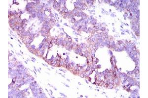 Immunohistochemical analysis of paraffin-embedded ovarian cancer tissues using CAMK4 mouse mAb with DAB staining.