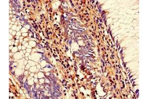 Immunohistochemistry of paraffin-embedded human colon cancer using ABIN7168833 at dilution of 1:100 (SENP1 Antikörper  (AA 63-214))