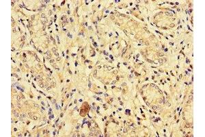 Immunohistochemistry of paraffin-embedded human gastric cancer using ABIN7151827 at dilution of 1:100 (EPHA1 Antikörper  (AA 296-414))