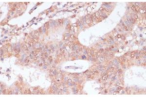 Immunohistochemistry of paraffin-embedded Human colon carcinoma using BYSL Polyclonal Antibody at dilution of 1:100 (40x lens). (Bystin-Like Antikörper)