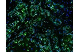 IF analysis of Emerin using anti-Emerin antibody (ABIN4886569) Emerin was detected in paraffin-embedded section of human oesophagus squama cancer tissues. (Emerin Antikörper  (N-Term))