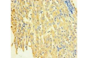 Immunohistochemistry of paraffin-embedded human liver cancer using ABIN7171249 at dilution of 1:100 (STX8 Antikörper  (AA 1-215))